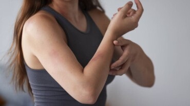 a woman with a skin rash a woman with a skin rash
