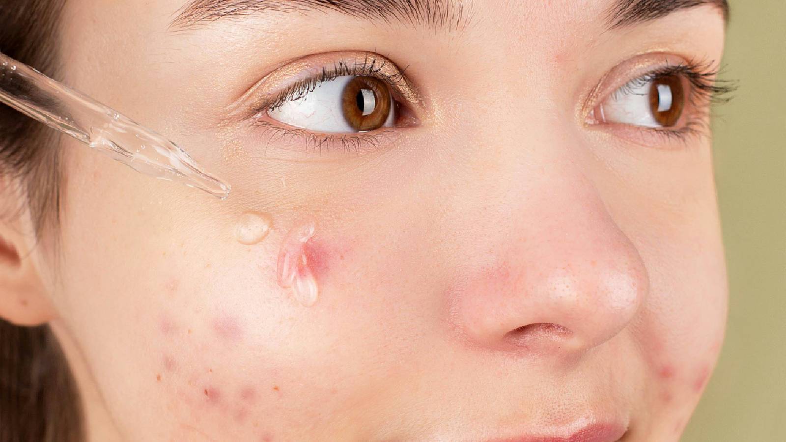 A woman with acne, applying serum