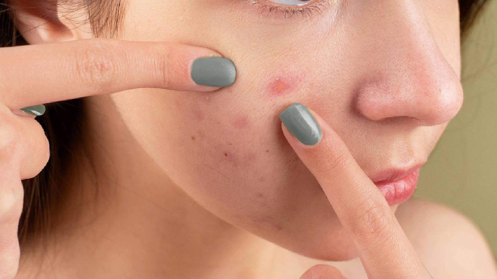 A woman with acne