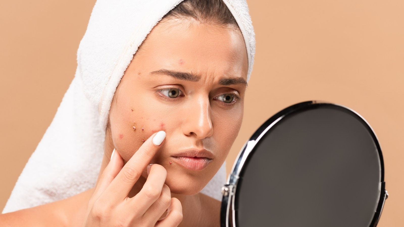 Cystic acne Source AdobeStock